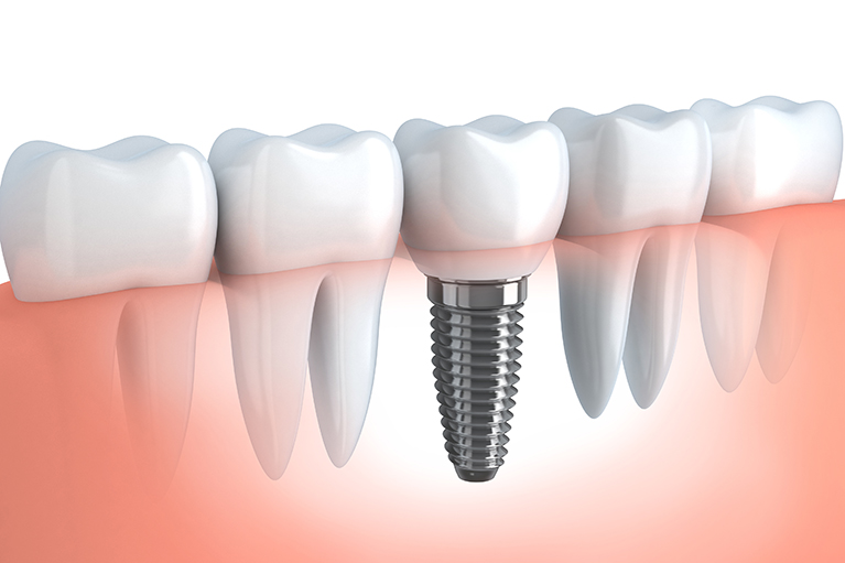 チタン製の人工の歯を埋め込む治療